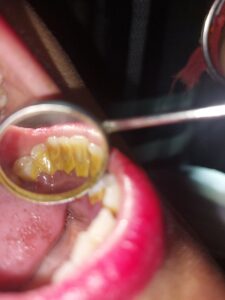 Calculus or hard deposit on teeth
